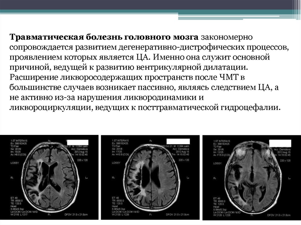 Признаки атрофии головного мозга. Травматическая болезнь головного мозга периоды. Понятие о травматической болезни головного мозга. Дегенеративные процессы в головном мозге. Этапы развития травматического заболевания головного мозга.