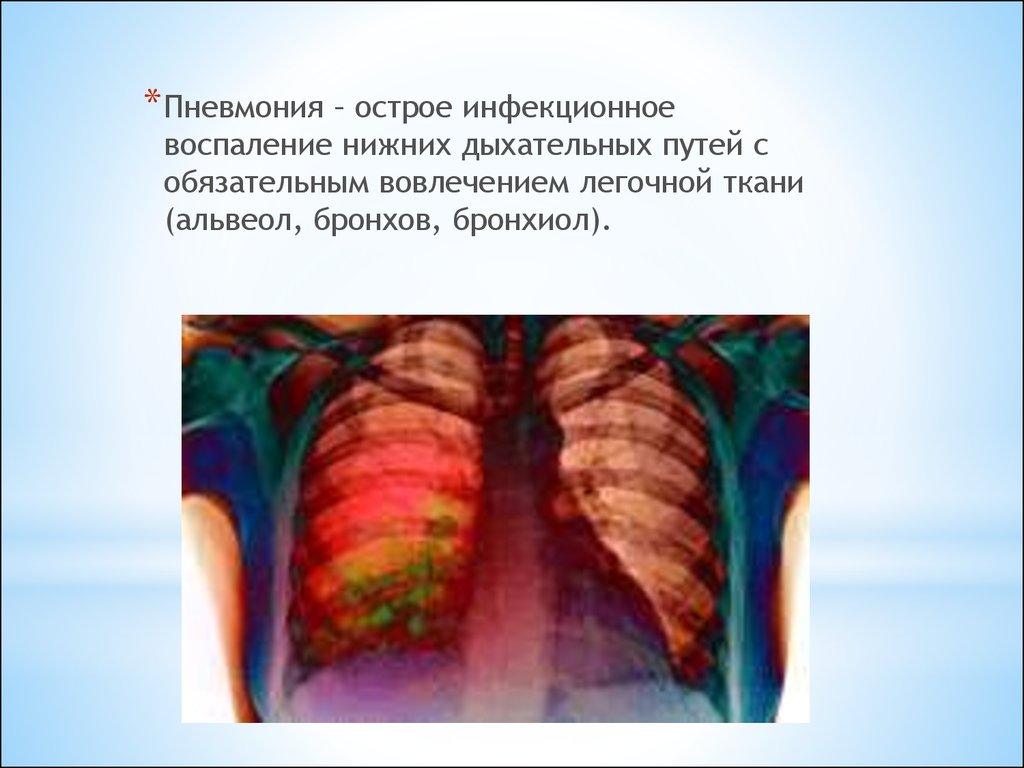 Легочная ткань. Септическая пневмония. Воспаление нижних дыхательных путей. Острое воспаление легких. Острые инфекции нижних дыхательных путей.