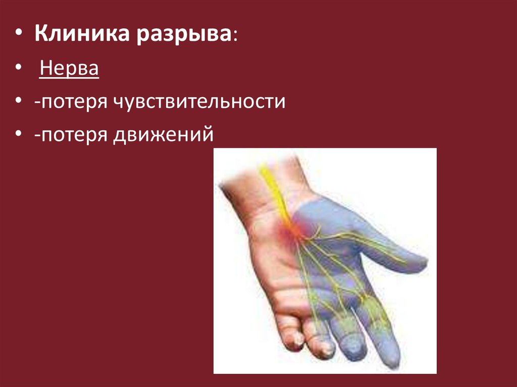 Клиника разрыва. Нейропатия нерва руки потеря чувствительности.