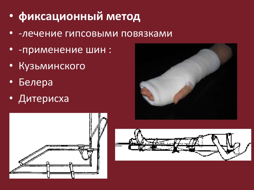 Метод процедура. Фиксационный метод лечения переломов показания. Фиксационный метод. Фиксационные шины повязки. Фиксационный метод лечения переломов гипсовой.