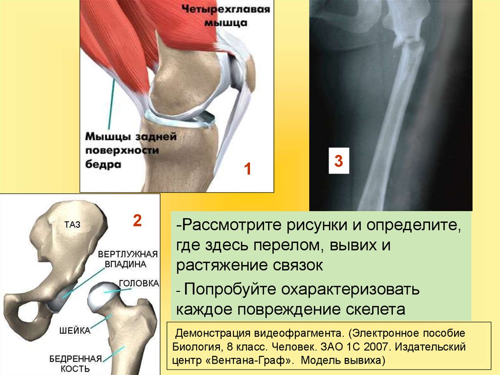 Первая помощь при ушибах переломах костей и вывихах суставов 8 класс презентация по биологии