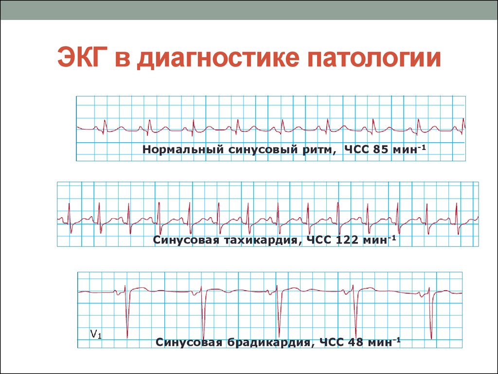 Патологии на экг фото с расшифровкой