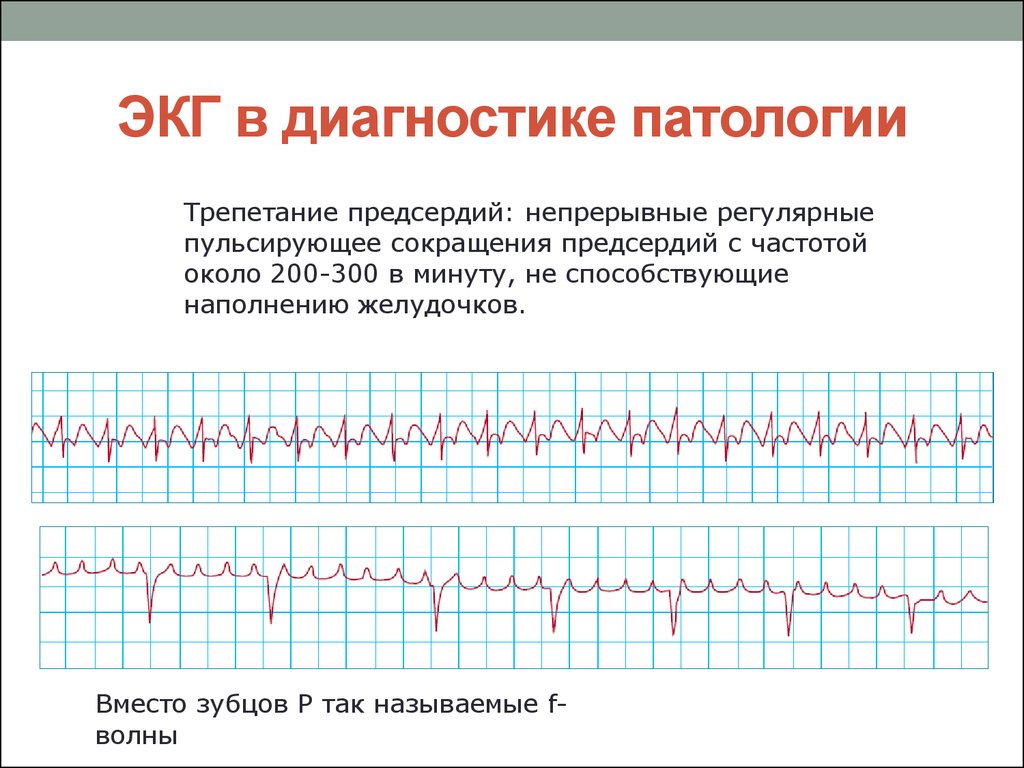 Фибрилляция предсердий на экг. Патология ЭКГ фибрилляция предсердии. Трепетание предсердий патологическая ЭКГ. Диагноз: трепетание предсердий ЭКГ. Трепетание предсердий на ЭКГ признаки.