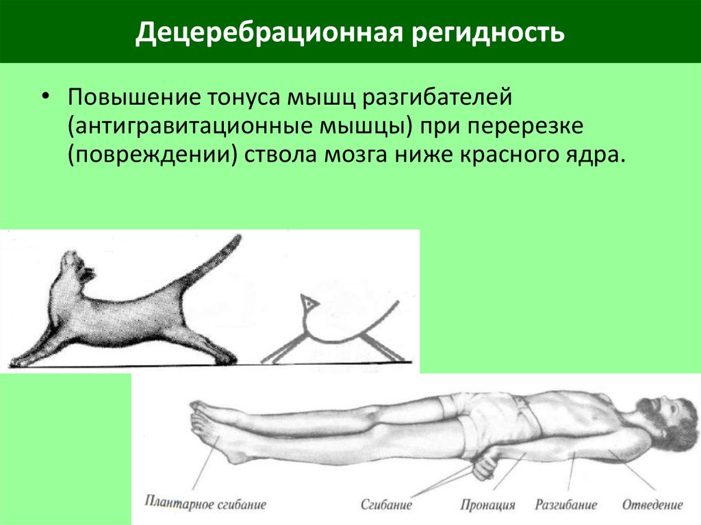 Повышение мышечной. Повышение мышечного тонуса. Повышение тонуса мышц разгибателей. Децеребрационная ригидность мышц. Повышение мвшечноно тоеума.