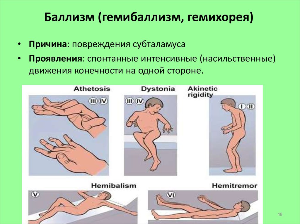 Движение конечностей. Гемихорея гемибаллизм. Виды гиперкинезов. Непроизвольные движения в конечностях. Клинические проявления баллизма гемибаллизма.