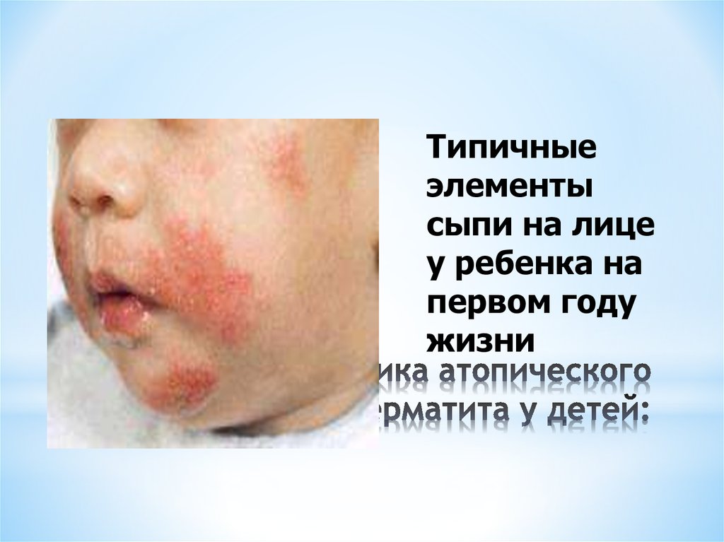 Клиника атопического дерматита у детей: