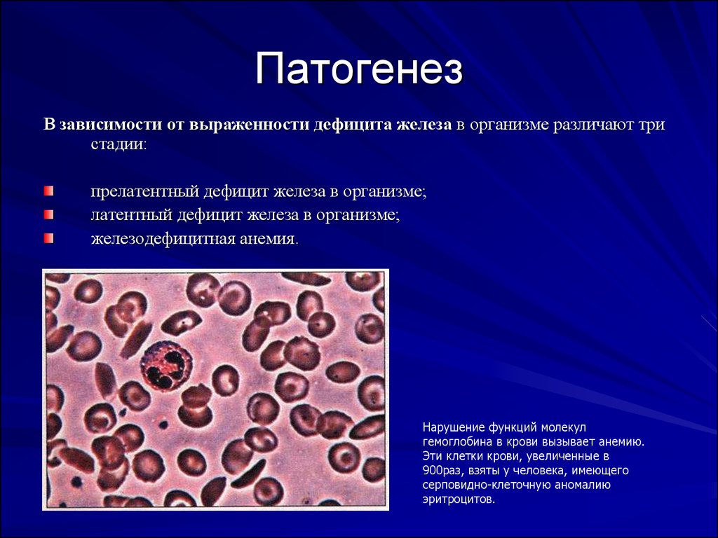 Схема патогенеза железодефицитной анемии