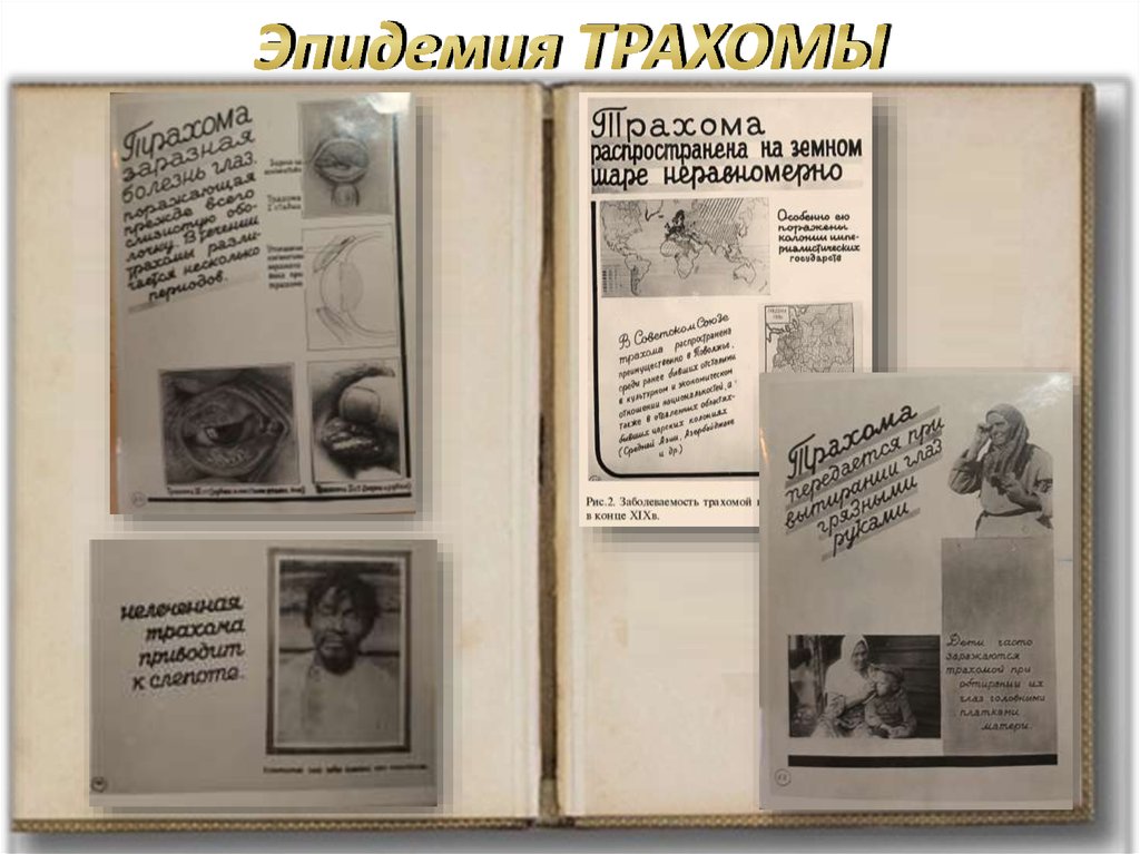 Эпидемия ТРАХОМЫ