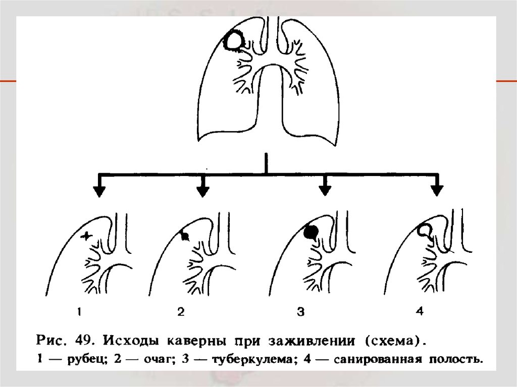 Цирротический туберкулез легких рисунок