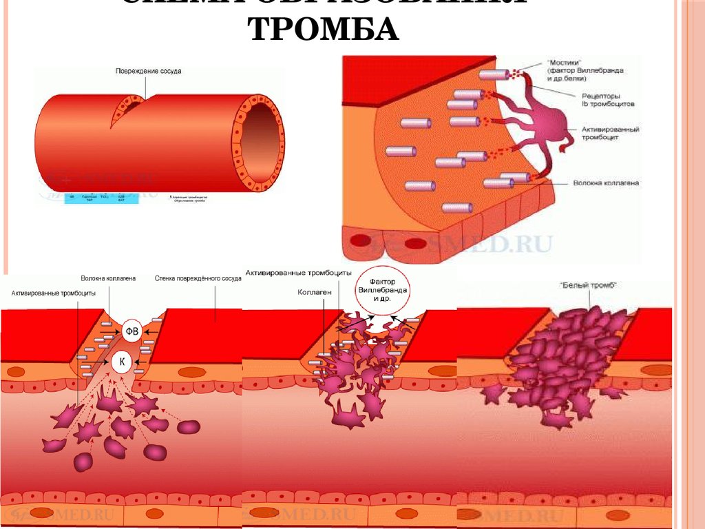 Механизм тромбоза. Схема образования красного тромба. Тромбоциты повреждение сосуда схема. Тромбоз механизм тромбообразования. Этапы образования тромба схема.