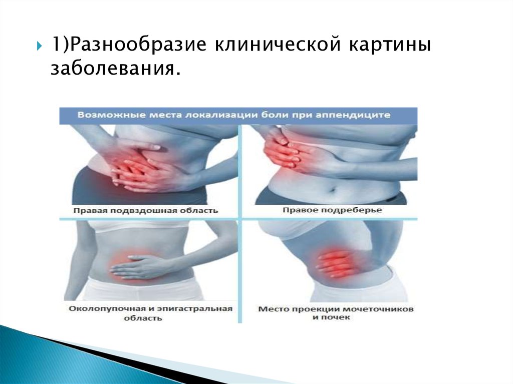 Разнообразие клинической картины при остром аппендиците связано с