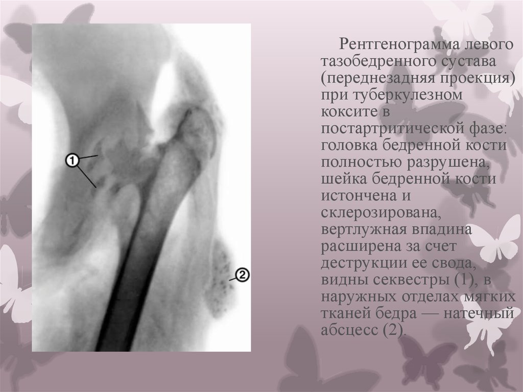 Коксит. Туберкулезный остит бедренной кости. Кокситный туберкулез тазобедренного сустава. Костный туберкулез рентген тазобедренный сустав. Туберкулезный коксит рентген.