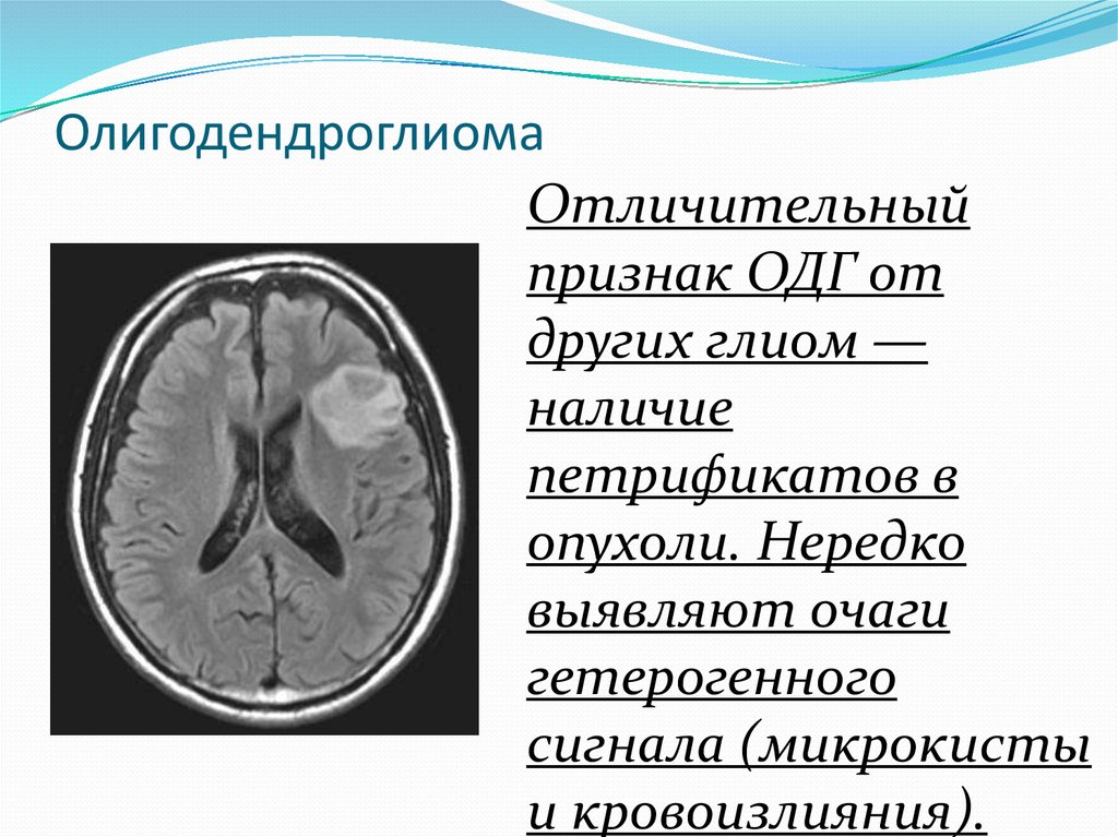 Олигодендроглиома