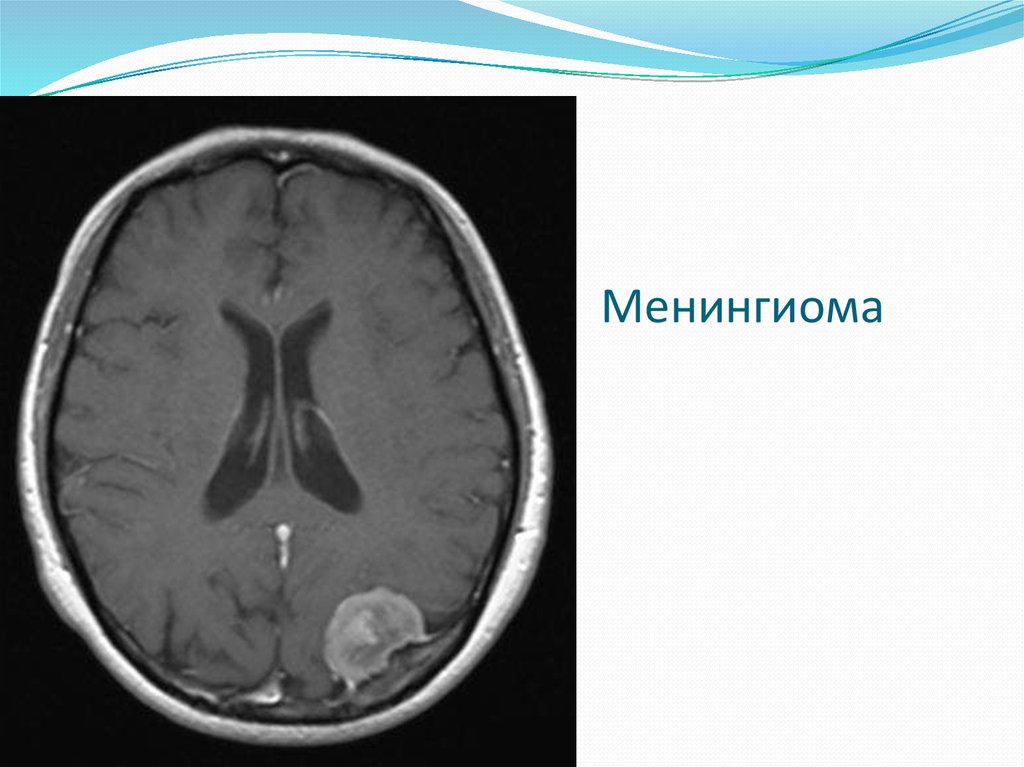 Можно ли принимать при менингиоме. Менингиома гистология классификация. Менингиома головного мозга макропрепарат. Можно ли принимать при менингиоме. Рабдоидная менингиома.