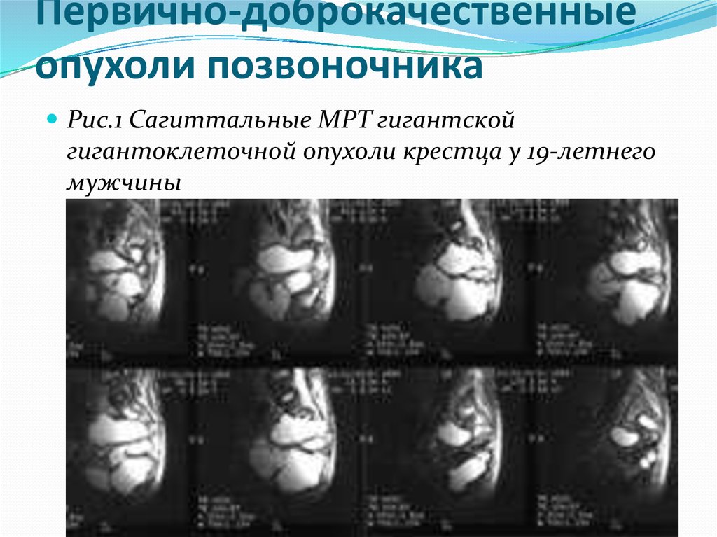 Первично-доброкачественные опухоли позвоночника