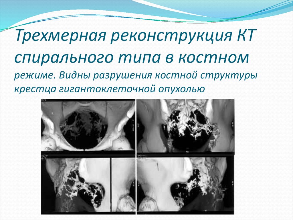 Трехмерная реконструкция КТ спирального типа в костном режиме. Видны разрушения костной структуры крестца гигантоклеточной