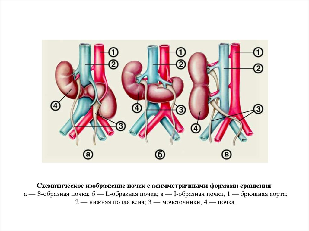 Пиявки на почки схема постановки