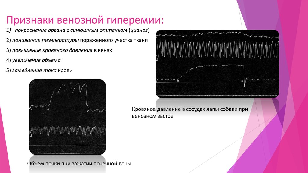 Признаки венозной гиперемии рисунок