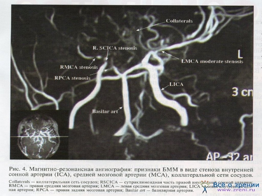 Форум аневризма мозга. ДСА сосудов головного мозга. Артериальные аневризмы сосудов головного мозга. Аневризма поверхностной вены головы. Аневризма сосудов головного мозга стендовый доклад.