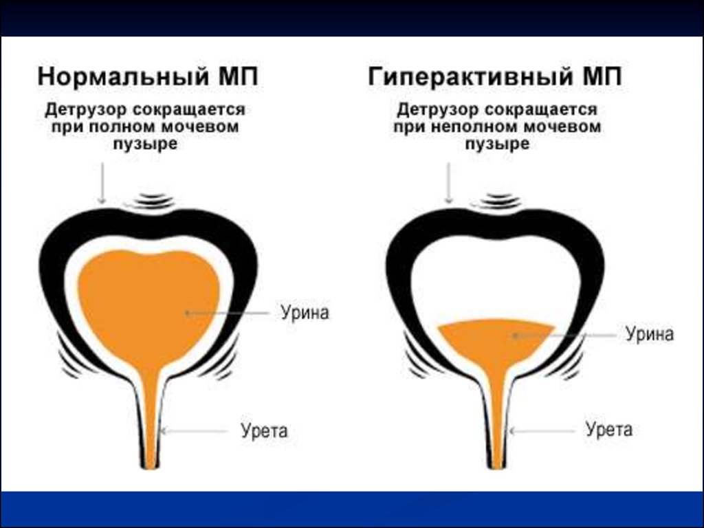 Гиперактивный мочевой пузырь презентация