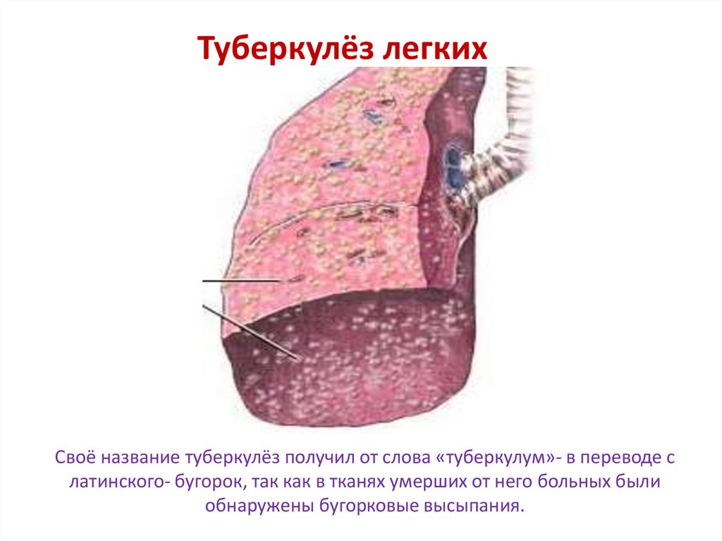 Туберкулез биология. Туберкулёз лёгких презентация.