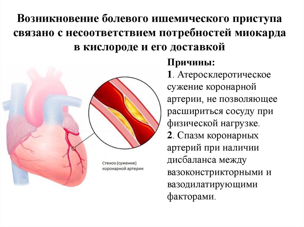 Ишемическая болезнь сосудов. ИБС атеросклеротическая болезнь сердца. Атеросклеротическое сужение коронарных артерий. Спазм коронарных артерий причины. Спазм коронарных сосудов причины.