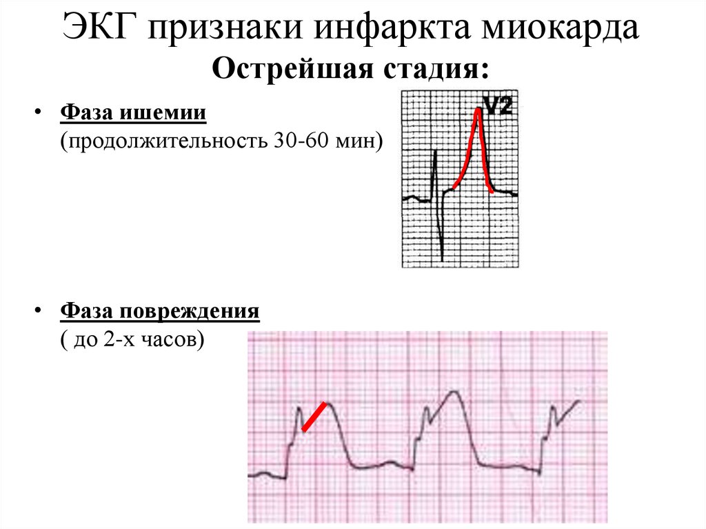 Экг инфаркт миокарда фото