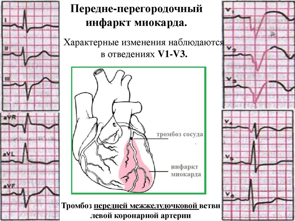 Незначительные изменения миокарда. Передне-перегородочный инфаркт миокарда. Острый передне перегородочный инфаркт ЭКГ. Септальный инфаркт миокарда на ЭКГ. Инфаркт миокарда боковой стенки на ЭКГ.