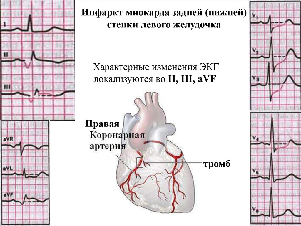 Незначительные изменения миокарда. Инфаркт миокарда нижнебоковой стенки. Острый инфаркт миокарда нижней стенки на ЭКГ. Старый инфаркт миокарда передней стенки ЭКГ. Нижне диафрагмальный инфаркт миокарда на ЭКГ.