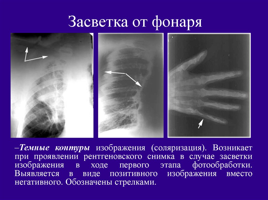 Негативное изображение рентген