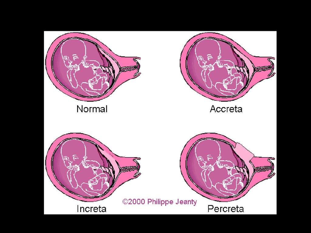 Плацента на рубце матки. Степени врастания плаценты. Плацента Accreta increta percreta. Врастание плаценты в матку.