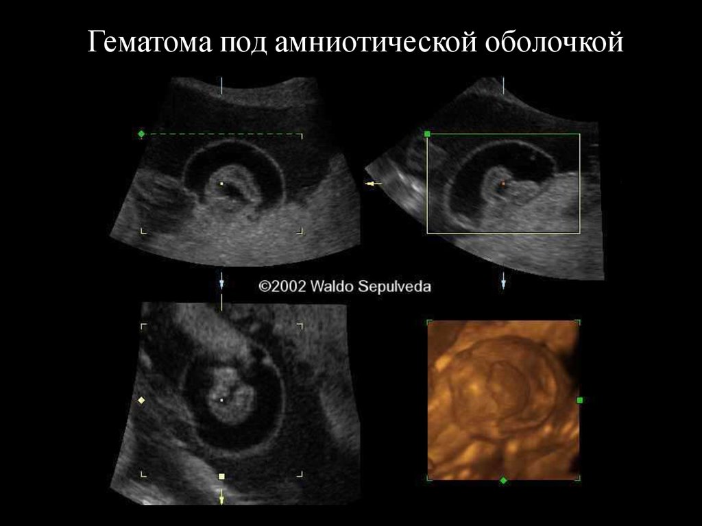 Отслойка 8 недель. Отслойка на 6 неделе беременности УЗИ. УЗИ беременность 6 недель с гематомой. Гематома при беременности на ранних УЗИ.