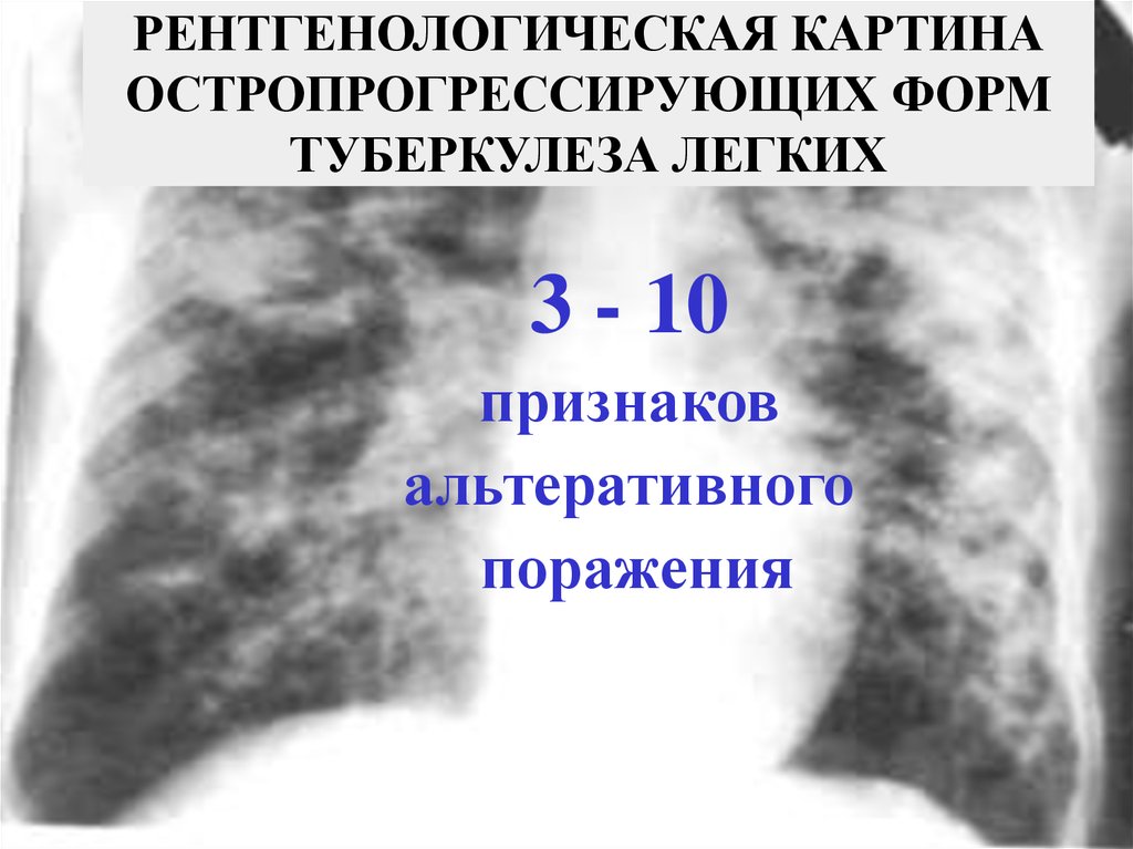 Какие симптомы туберкулеза у взрослых. Рентгенологическая картина. Рентгенодиагностика туберкулеза. Проявление туберкулеза. Легочные проявления туберкулеза.