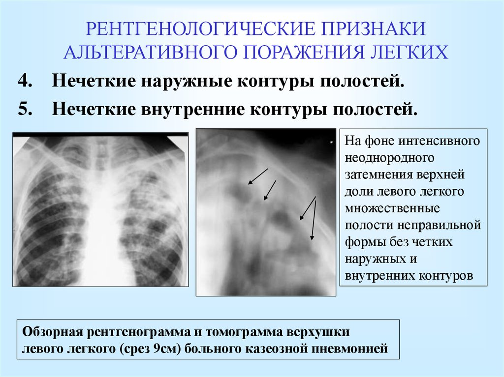 Поражения правого легкого. Рентгенологические признаки. Признаки поражения легких. Признаки поражения лёгкого.