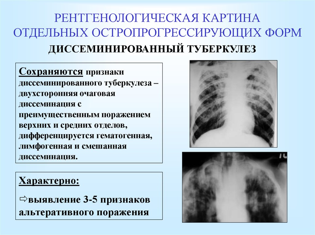 Формы диссеминированного туберкулеза. Подострый диссеминированный туберкулез рентген. Рентгенологические синдромы диссеминированного туберкулеза. Острый диссеминированный туберкулез рентген. Клинические синдромы диссеминированного туберкулеза.