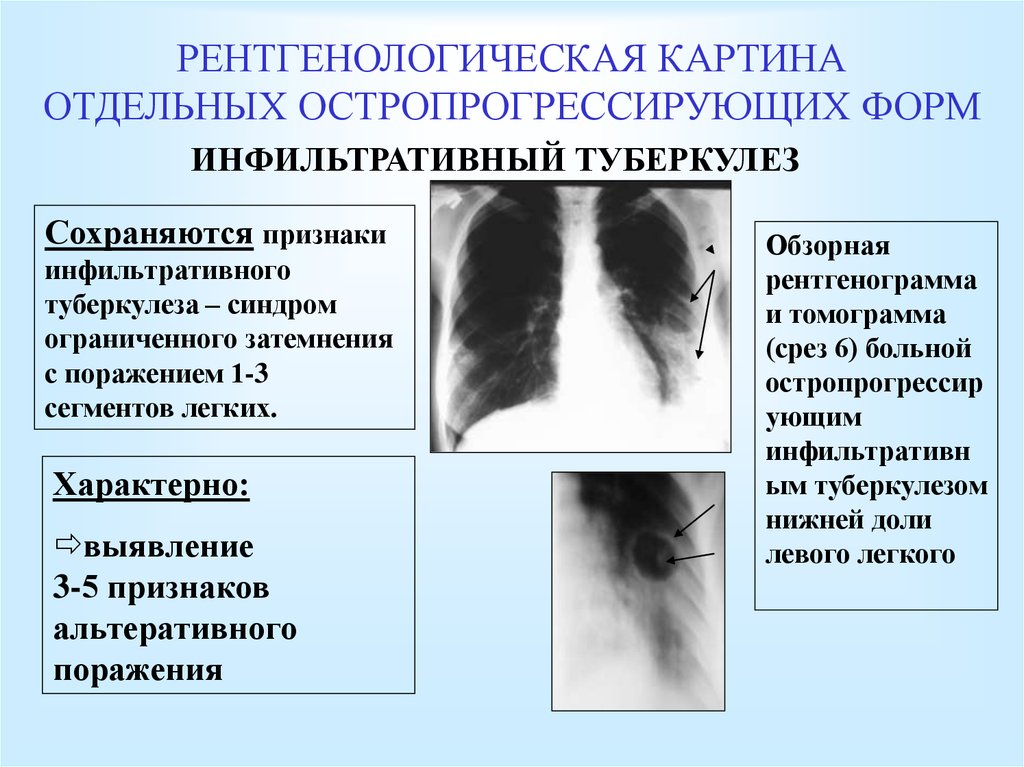 Рентгенологические синдромы легких. Инфильтративный туберкулез рентгенологический синдром. Инфильтративный туберкулез синдромы рентген. Диссеминированный туберкулез рентгенологические синдромы. Инфильтративный туберкулез классификация рентген.