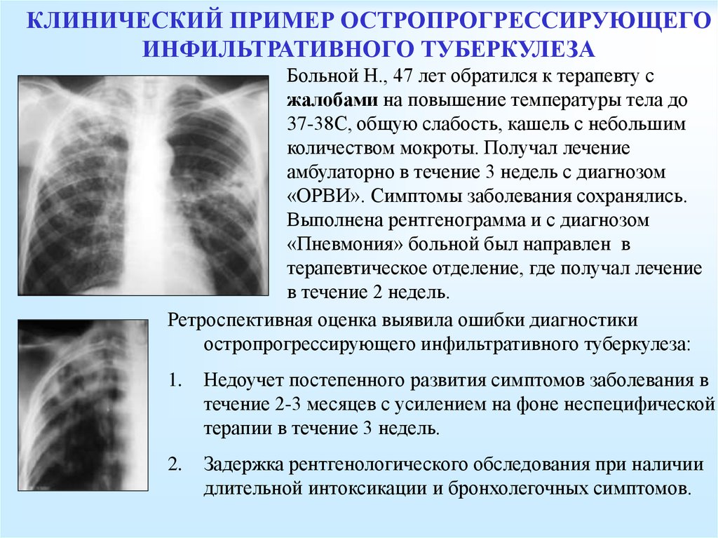 Остаточные после бронхита. Клинические симптомы инфильтративного туберкулеза. Лобулярный инфильтративный туберкулез рентген. Инфильтративный туберкулез верхней доли рентген. Инфильтративная форма туберкулеза на рентгене легких.