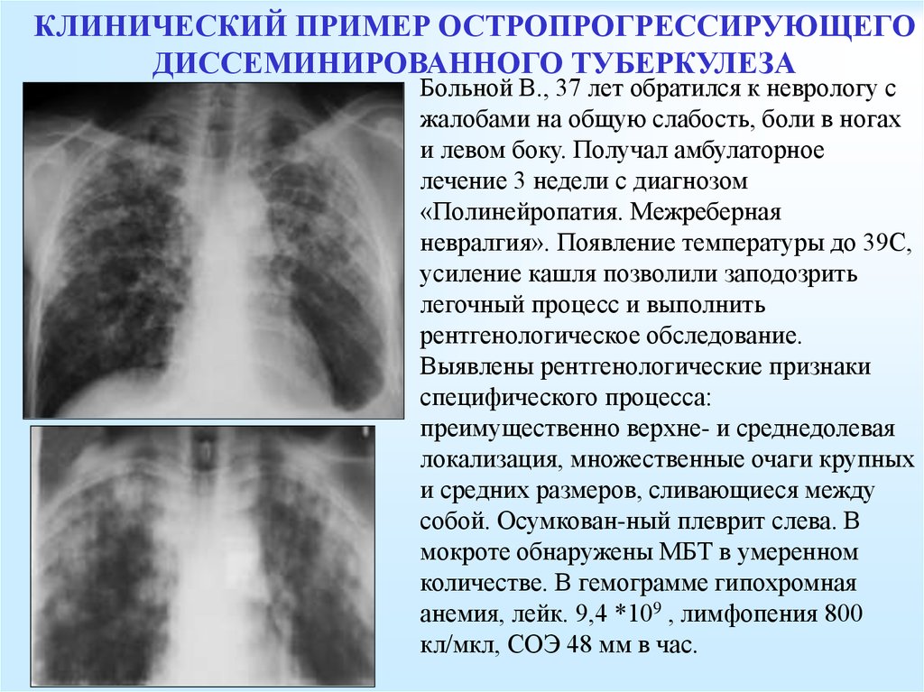 Начальная стадия туберкулеза у взрослых. Диссеминированный туберкулез симптомы. Подострый диссеминированный туберкулез рентген. Диссеминированный туберкулез на рентгенограмме. Диссеминированный туберкулез рентген стадий.