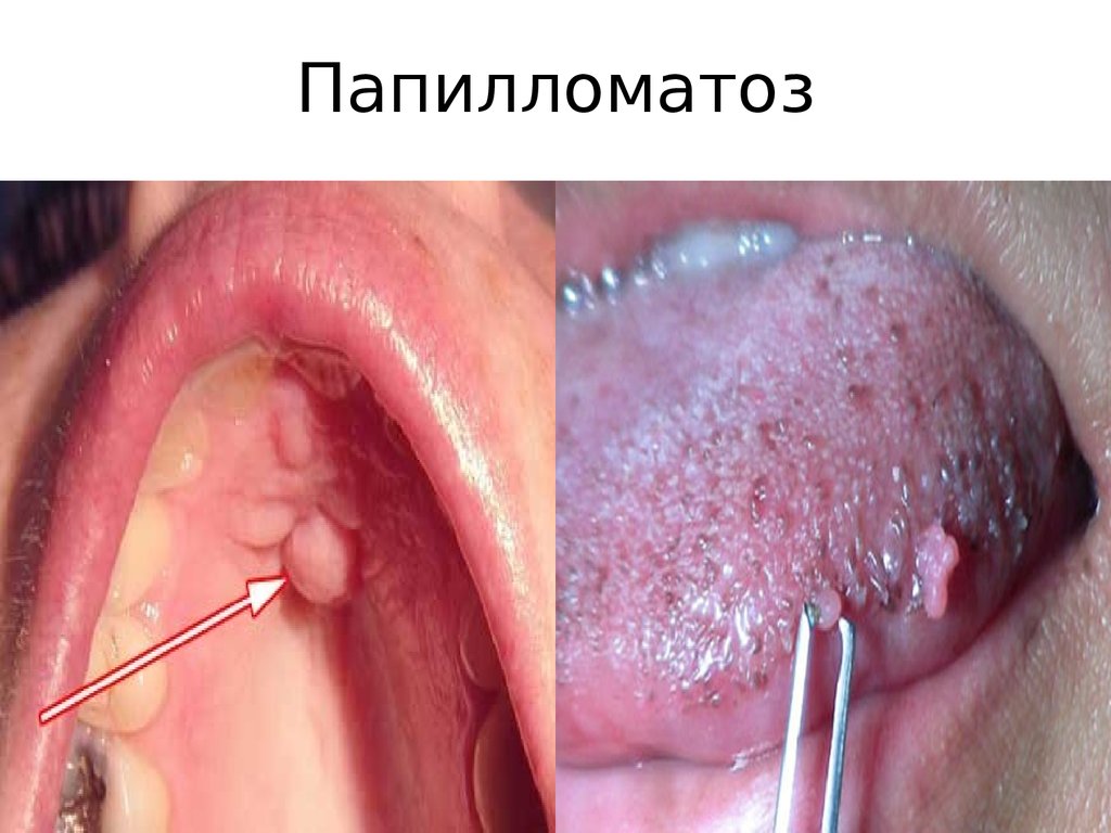 Папилломатоз