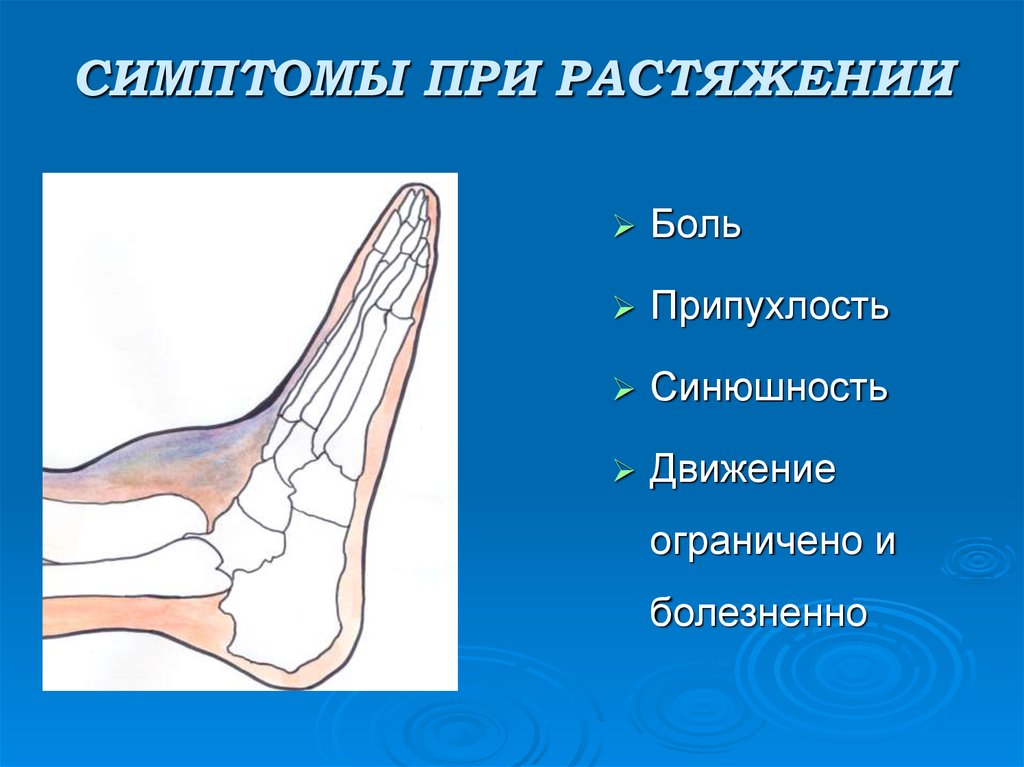 Растяжение признаки. Растяжение связок симптомы. Растяжение клинические проявления. Основные признаки растяжения.