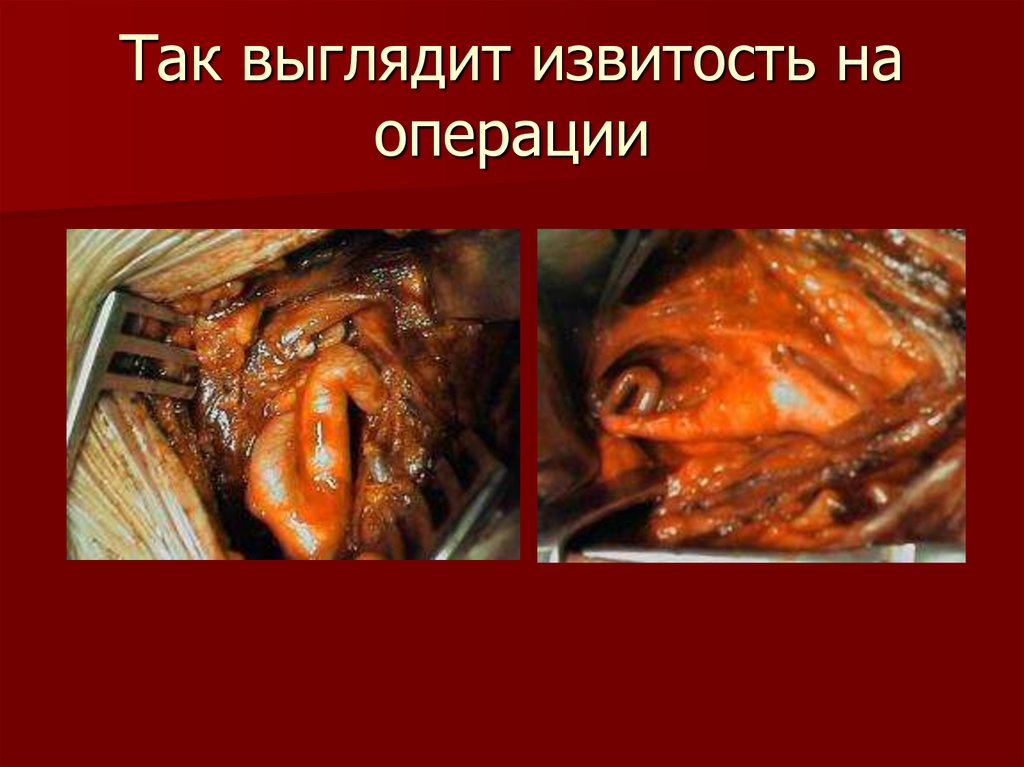 Так выглядит извитость на операции