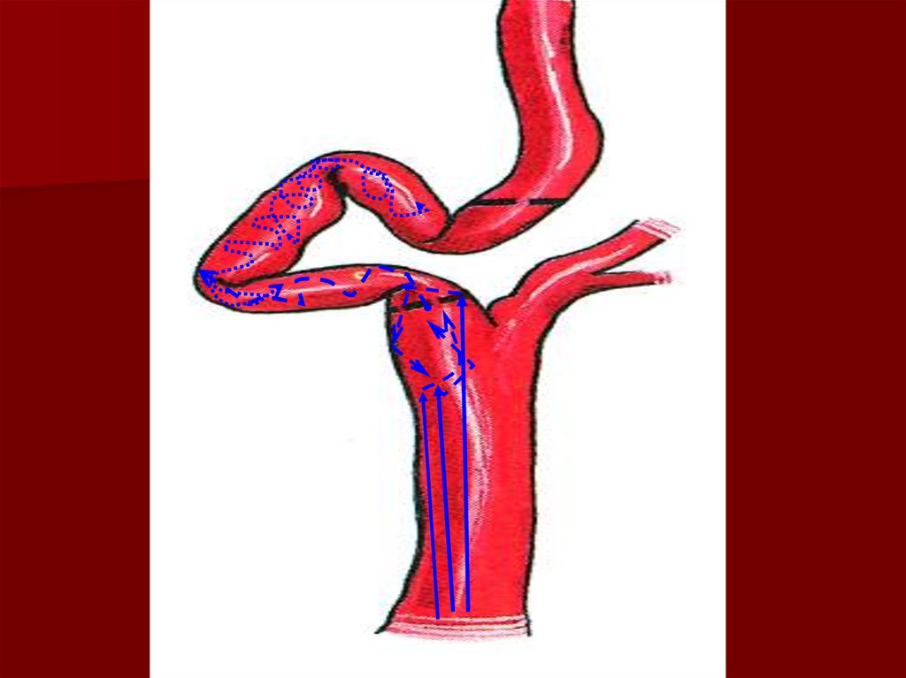 Изгиб вса. Кинкинг и койлинг. Извитость ВСА кинкинг. Извитость сонных артерий. Петлеобразная извитость ВСА.