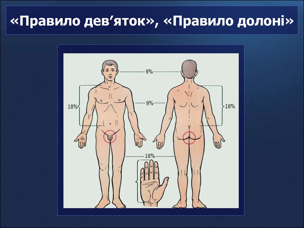 Правило девяток. Площадь ожога нижней конечности по правилу девятки:. Площадь ожога головы по правилу девяток. Правило девяток по хирургии.