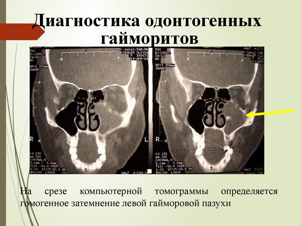 Одонтогенный верхнечелюстной синусит презентация