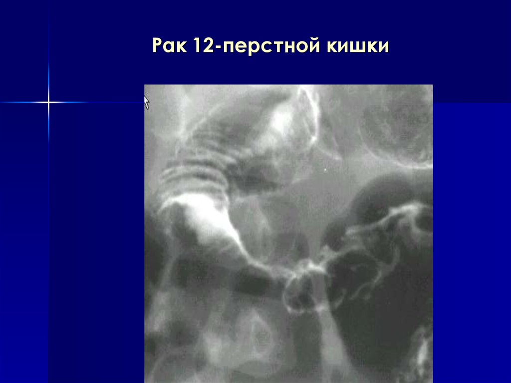 На основании сходной рентгенологической картины следует дифференцировать изменения пищевода при