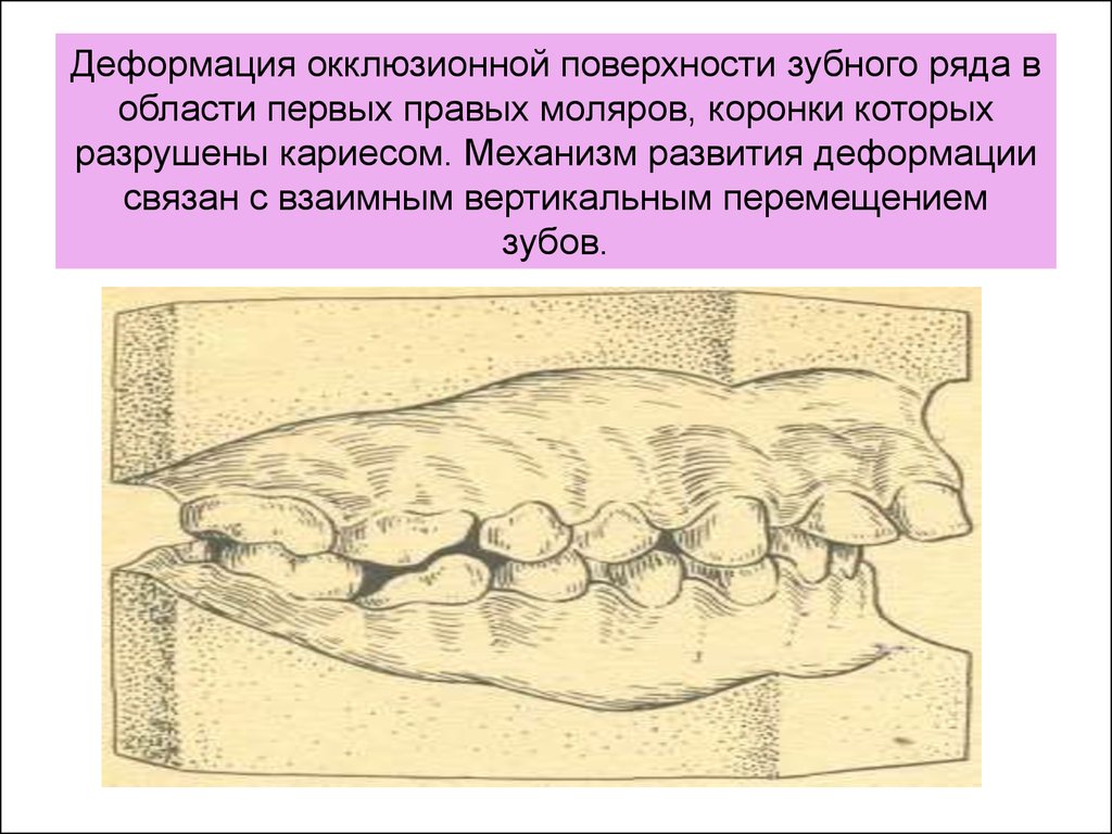 Идеальная схема окклюзионных контактов моляров и премоляров