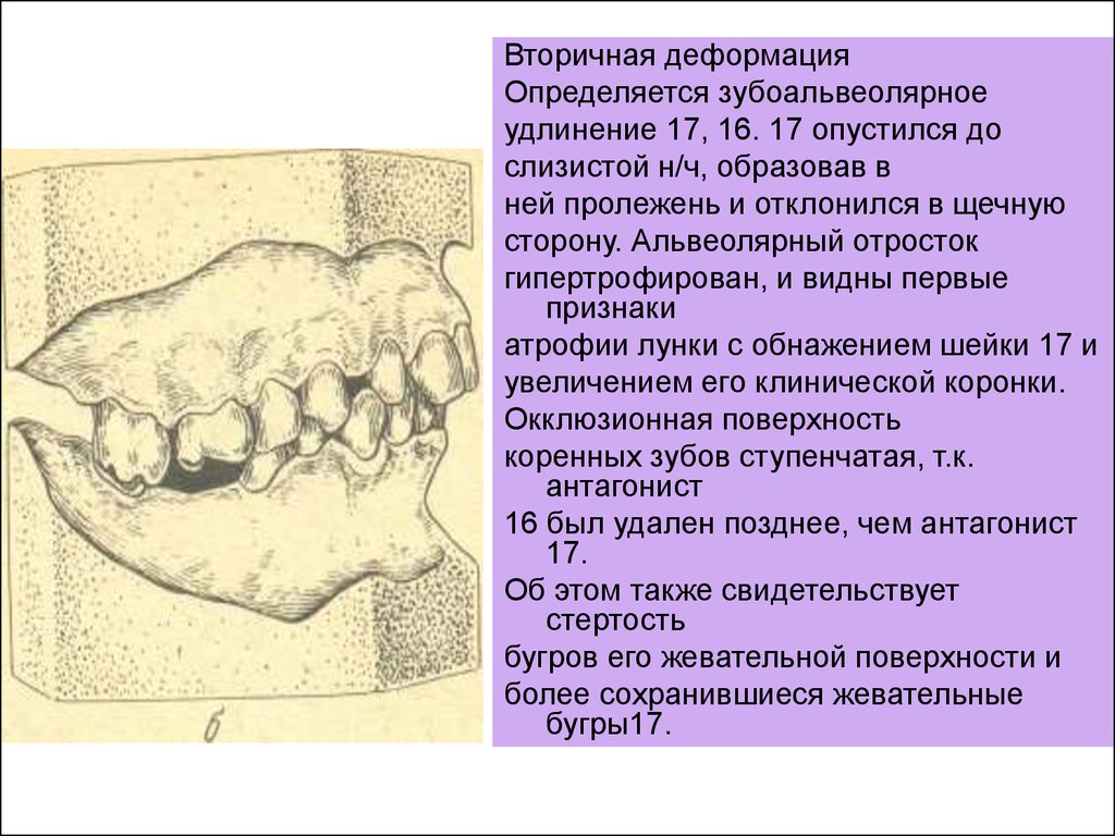 Слизистая альвеолярного отростка нижней челюсти. Зубоальвеолярное удлинение. Удлинение альвеолярных отростков. Зубо-альвелярное удлинение. Зубоальвеолярное деформация.