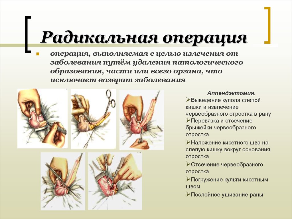 Радикальные и паллиативные. Виды радикальных операций. Радикальные хирургические операции. Виды хирургических вмешательств.