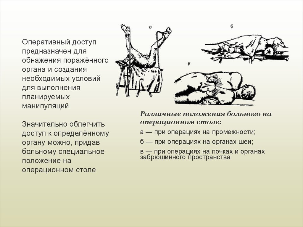 Различные положения. Позиции пациента на операционном столе при различных операциях. Способы укладки пациента на операционном столе. Положение пациента на операционном столе при аппендэктомии. Положение больного при операциях на шее.