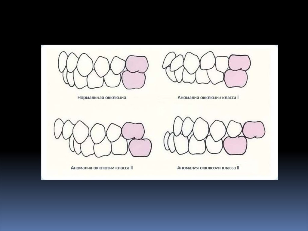 Мезиальная окклюзия презентация ортодонтия